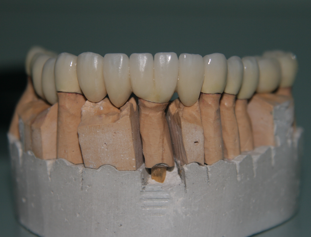 Два зъба върху един имплант